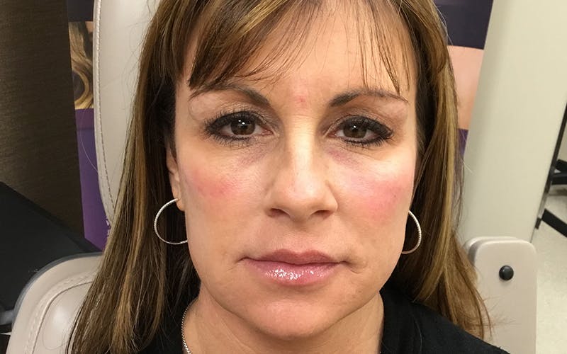 Dermal Fillers & Botox Before & After Gallery - Patient 264376 - Image 2