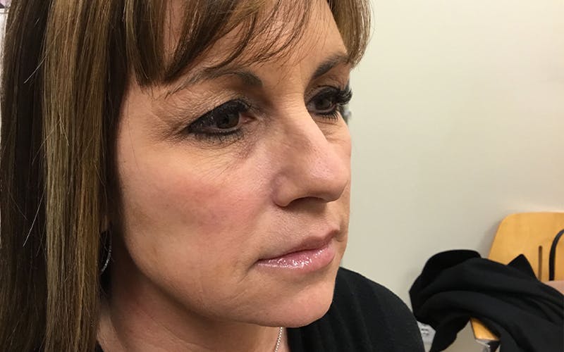 Dermal Fillers & Botox Before & After Gallery - Patient 264376 - Image 3