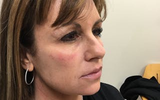 Dermal Fillers & Botox Before & After Gallery - Patient 264376 - Image 4