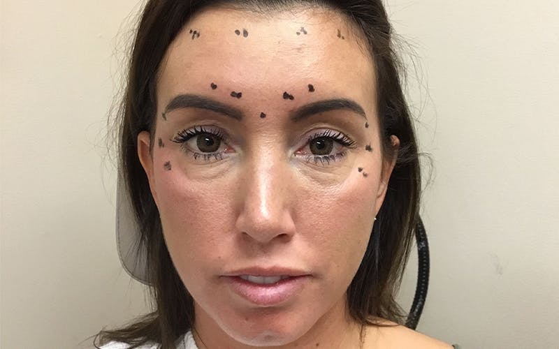 Dermal Fillers & Botox Before & After Gallery - Patient 332452 - Image 1