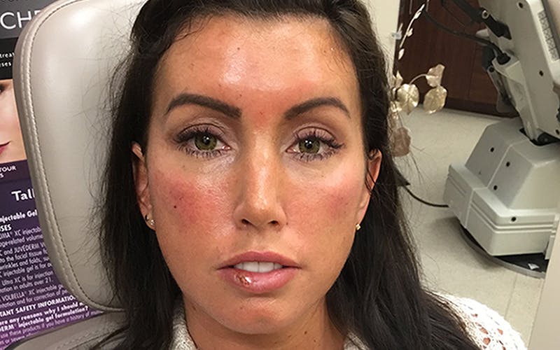 Dermal Fillers & Botox Before & After Gallery - Patient 332452 - Image 2