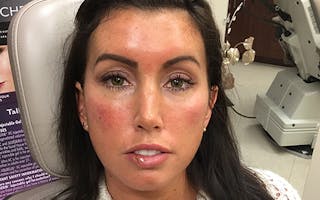 Dermal Fillers & Botox Before & After Gallery - Patient 332452 - Image 2