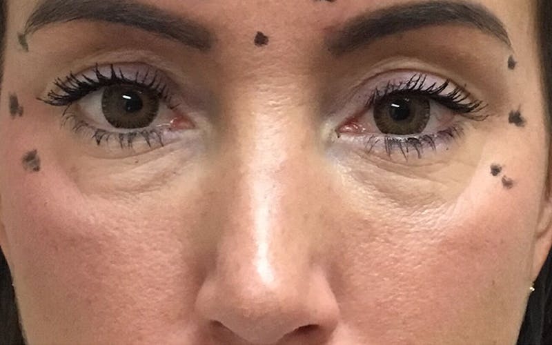 Dermal Fillers & Botox Before & After Gallery - Patient 332452 - Image 3