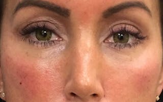 Dermal Fillers & Botox Before & After Gallery - Patient 332452 - Image 4