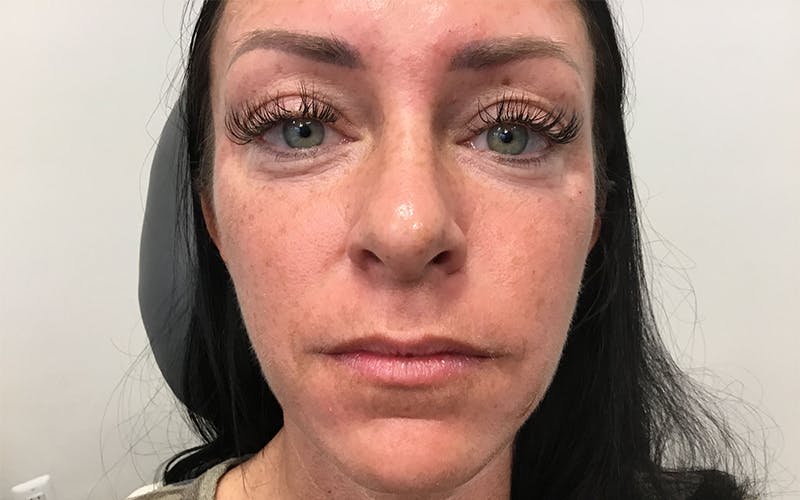 Dermal Fillers & Botox Before & After Gallery - Patient 415790 - Image 1