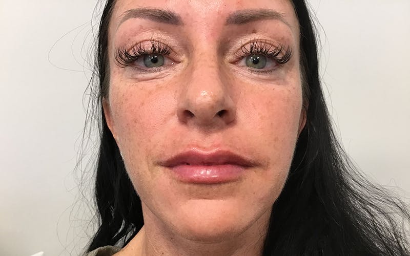Dermal Fillers & Botox Before & After Gallery - Patient 415790 - Image 2