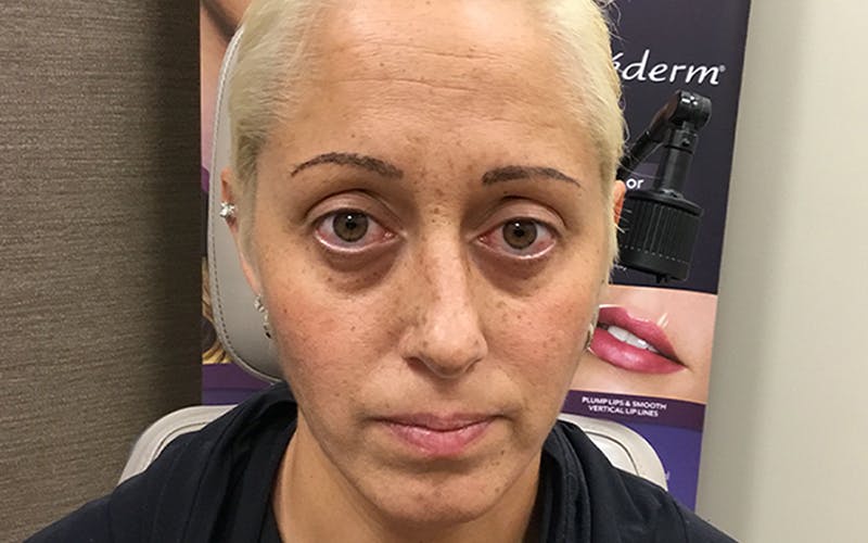Dermal Fillers & Botox Before & After Gallery - Patient 423222 - Image 1