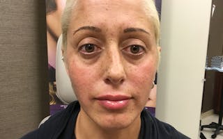 Dermal Fillers & Botox Before & After Gallery - Patient 423222 - Image 2