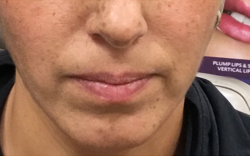 Dermal Fillers & Botox Before & After Gallery - Patient 423222 - Image 3