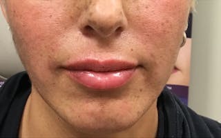 Dermal Fillers & Botox Before & After Gallery - Patient 423222 - Image 4