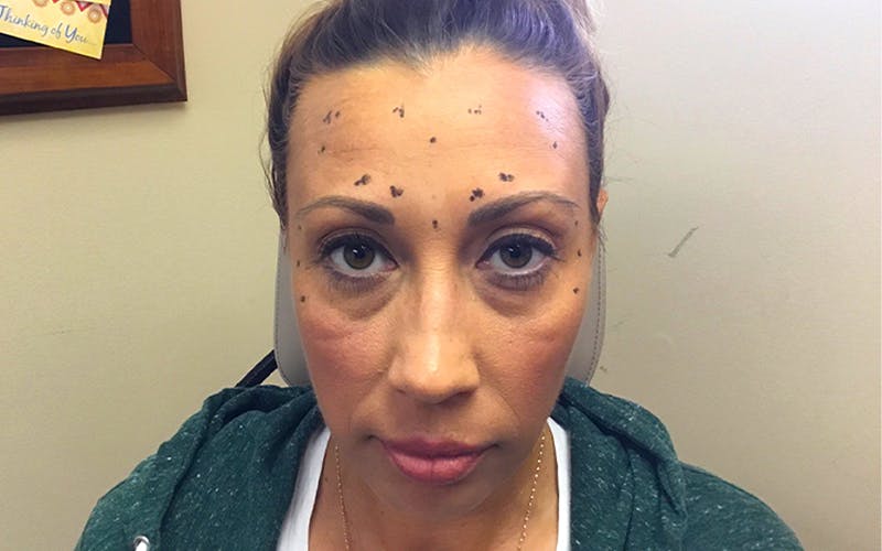 Dermal Fillers & Botox Before & After Gallery - Patient 206811 - Image 1