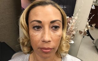 Dermal Fillers & Botox Before & After Gallery - Patient 206811 - Image 2