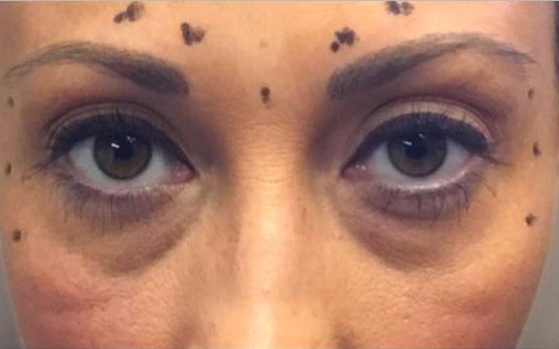 Dermal Fillers & Botox Before & After Gallery - Patient 206811 - Image 3