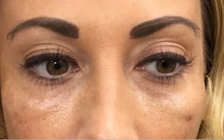 Dermal Fillers & Botox Before & After Gallery - Patient 206811 - Image 4