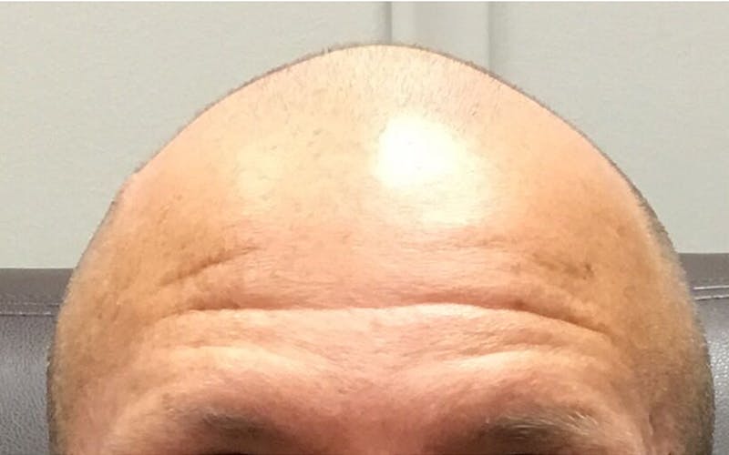 Dermal Fillers & Botox Before & After Gallery - Patient 421172 - Image 1