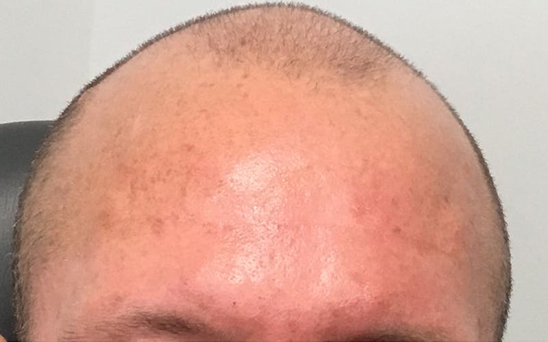 Dermal Fillers & Botox Before & After Gallery - Patient 421172 - Image 2