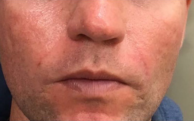 Dermal Fillers & Botox Before & After Gallery - Patient 421172 - Image 4