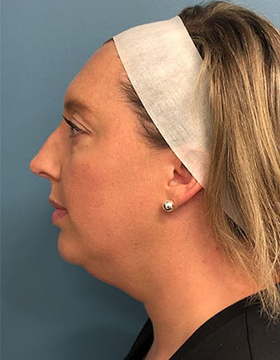 Renuvion Before & After Gallery - Patient 295056 - Image 1