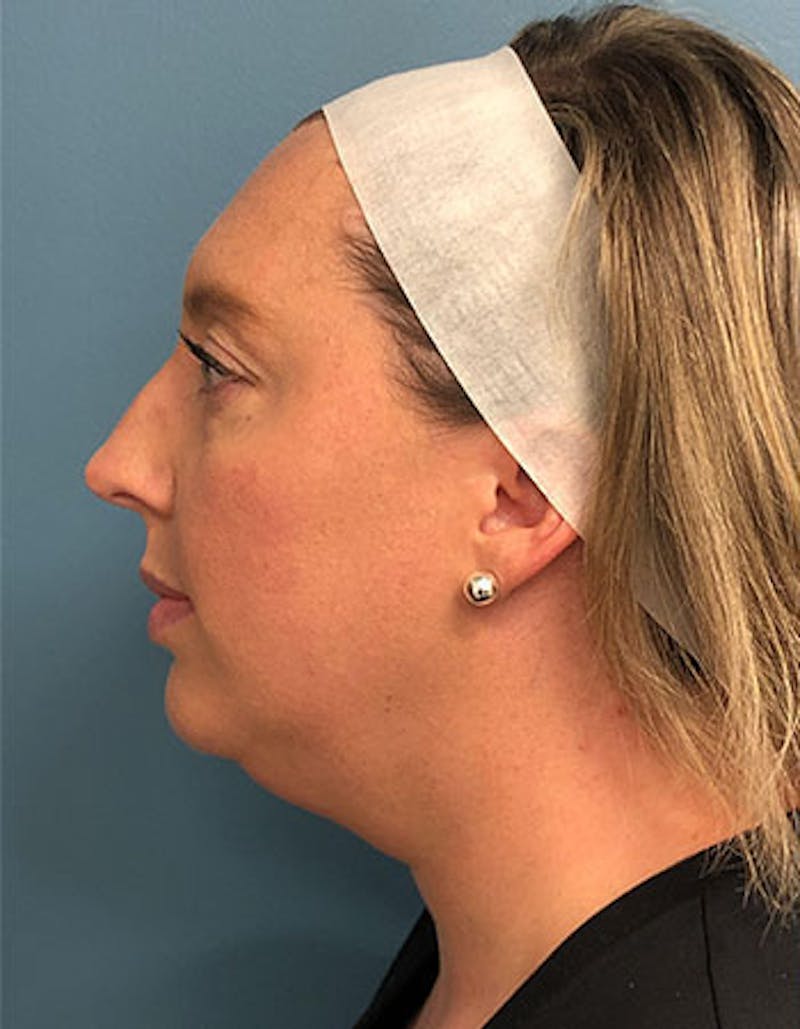 Renuvion Before & After Gallery - Patient 295056 - Image 1