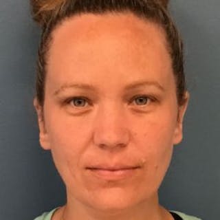 Ear Surgery Before & After Gallery - Patient 178703 - Image 2