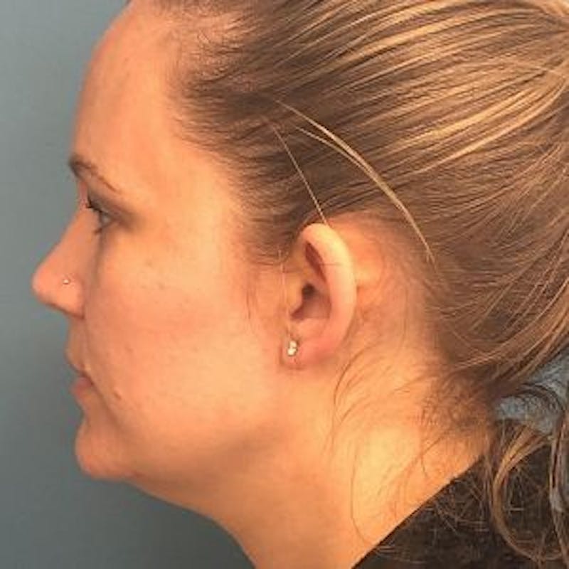 Ear Surgery Before & After Gallery - Patient 178703 - Image 3