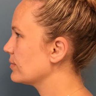 Ear Surgery Before & After Gallery - Patient 178703 - Image 4