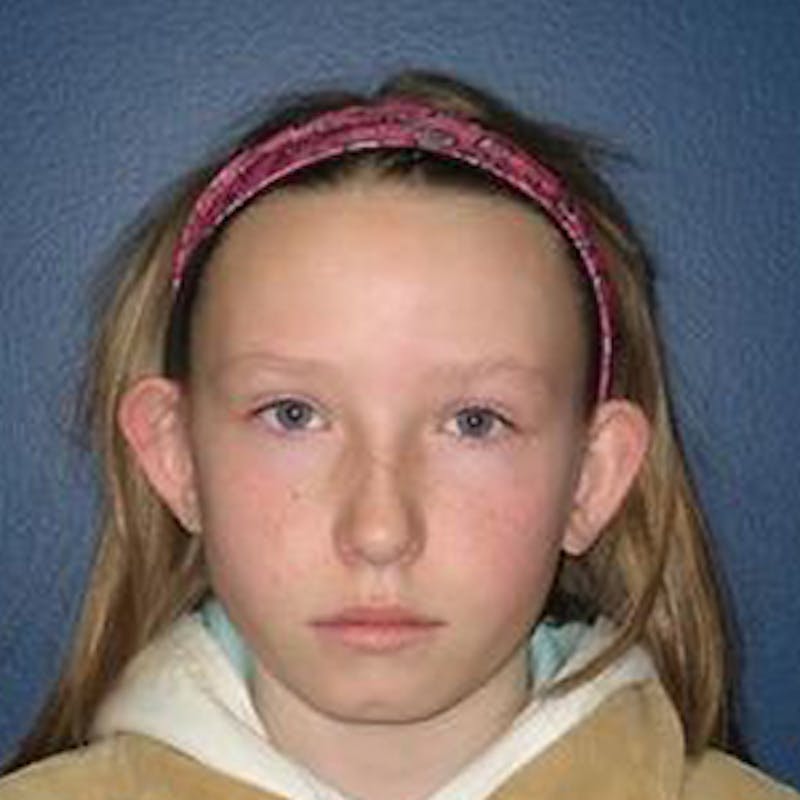 Ear Surgery Before & After Gallery - Patient 274018 - Image 1