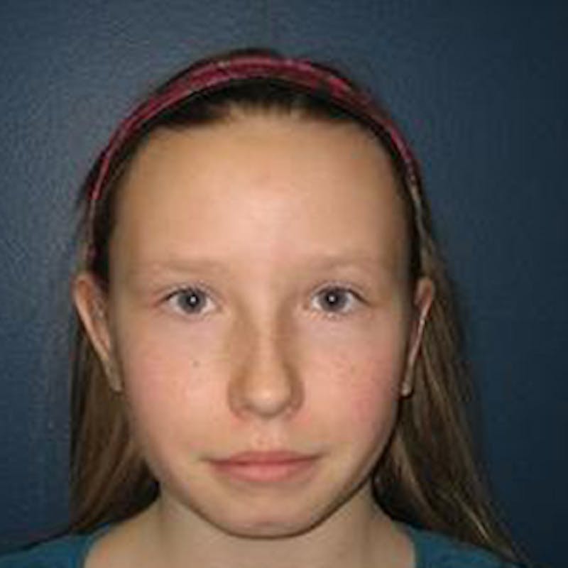Ear Surgery Before & After Gallery - Patient 274018 - Image 2