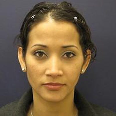 Ear Surgery Before & After Gallery - Patient 160899 - Image 1