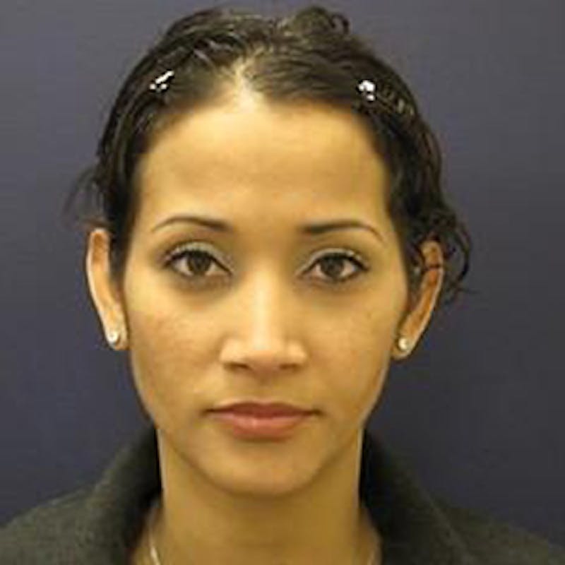 Ear Surgery Before & After Gallery - Patient 160899 - Image 1