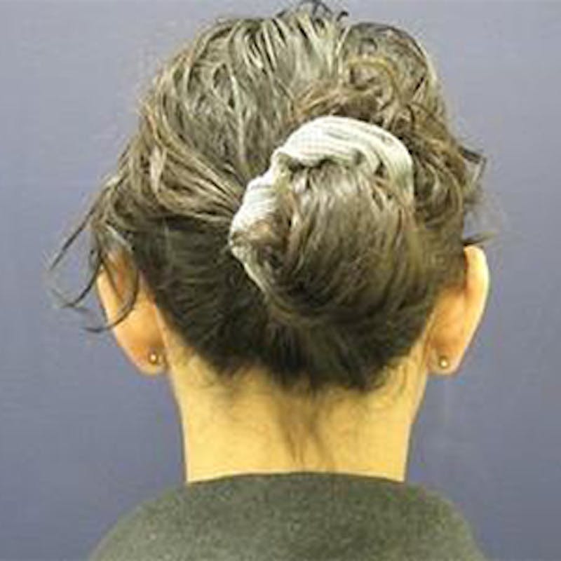 Ear Surgery Before & After Gallery - Patient 160899 - Image 3