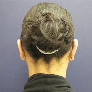 Ear Surgery Before & After Gallery - Patient 160899 - Image 4