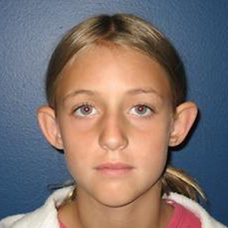 Ear Surgery Before & After Gallery - Patient 244940 - Image 1