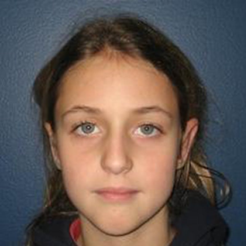 Ear Surgery Before & After Gallery - Patient 244940 - Image 2