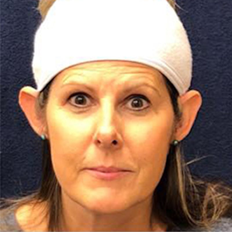 Ear Surgery Before & After Gallery - Patient 423114 - Image 1