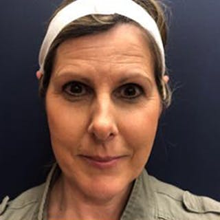 Ear Surgery Before & After Gallery - Patient 423114 - Image 2