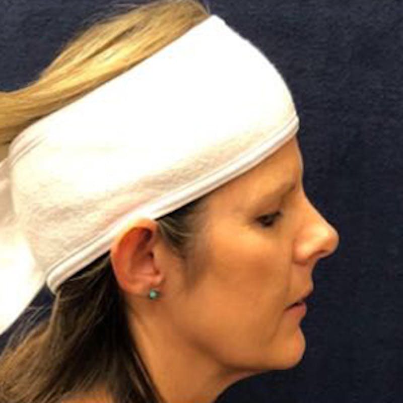 Ear Surgery Before & After Gallery - Patient 423114 - Image 3