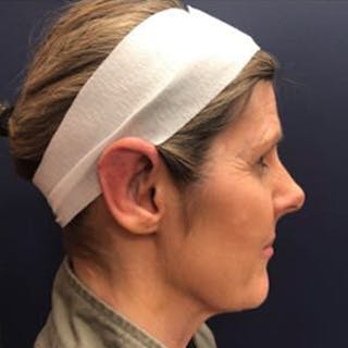 Ear Surgery Before & After Gallery - Patient 423114 - Image 4