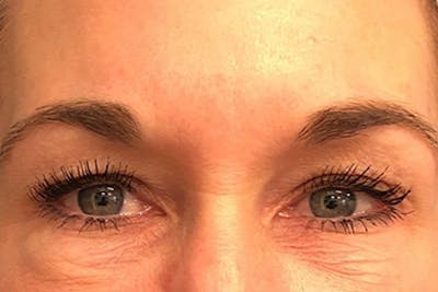 Eyelid Surgery Before & After Gallery - Patient 133283 - Image 1