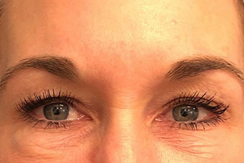 Eyelid Surgery Before & After Gallery - Patient 133283 - Image 1