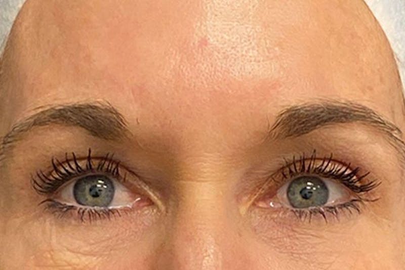 Eyelid Surgery Before & After Gallery - Patient 133283 - Image 2