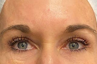Eyelid Surgery Before & After Gallery - Patient 133283 - Image 2