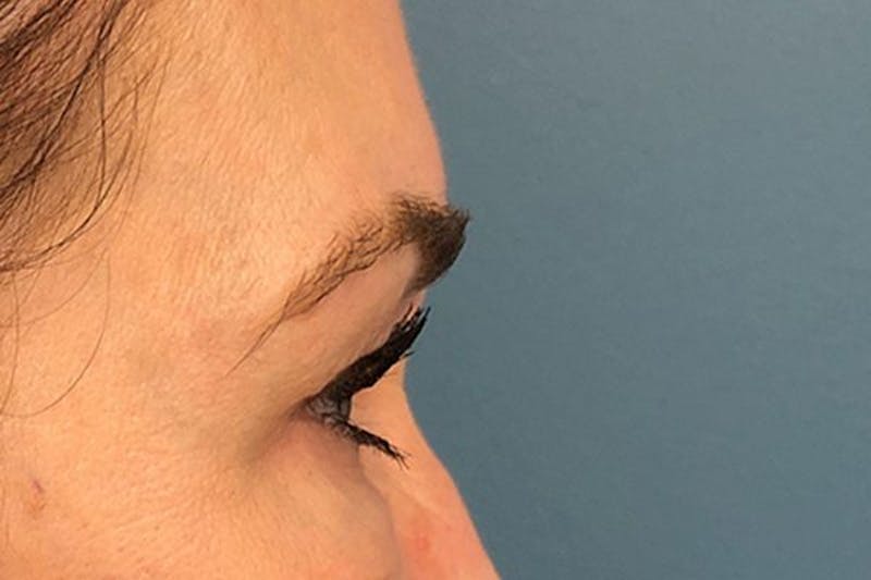 Eyelid Surgery Before & After Gallery - Patient 133283 - Image 3