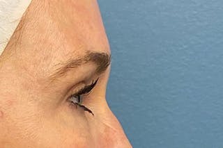 Eyelid Surgery Before & After Gallery - Patient 133283 - Image 4