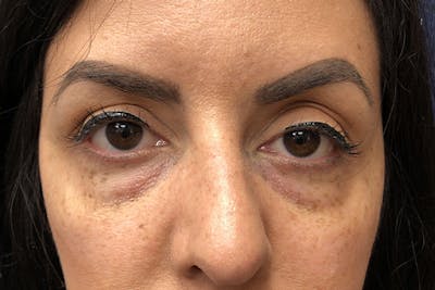 Eyelid Surgery Before & After Gallery - Patient 288974 - Image 1