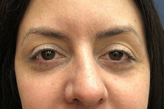 Eyelid Surgery Before & After Gallery - Patient 288974 - Image 2