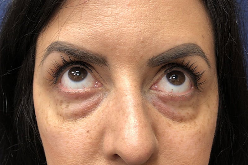 Eyelid Surgery Before & After Gallery - Patient 288974 - Image 3