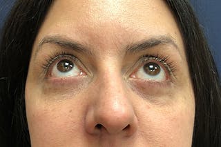 Eyelid Surgery Before & After Gallery - Patient 288974 - Image 4