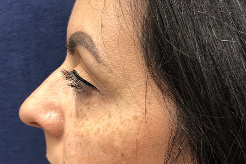 Eyelid Surgery Before & After Gallery - Patient 288974 - Image 5