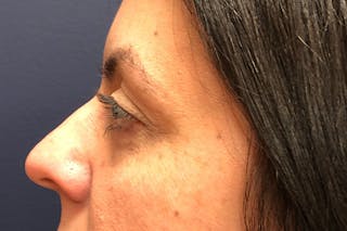 Eyelid Surgery Before & After Gallery - Patient 288974 - Image 6
